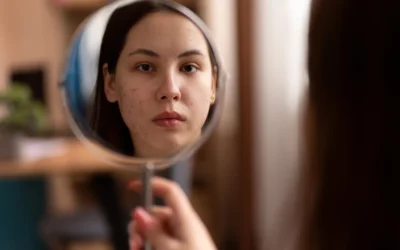 Cara Menghilangkan Jerawat Batu Secara Efektif dan Aman