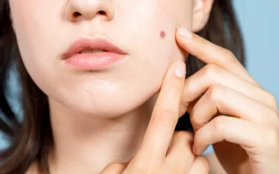 Cara Menghilangkan Bekas Jerawat yang Menghitam dengan Cepat