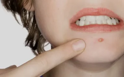 Mengatasi Jerawat di Dagu: Penyebab, Cara Menghilangkan, dan Tips Pencegahannya