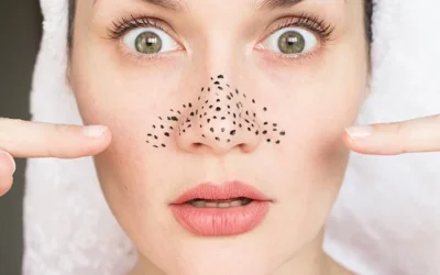 Komedo Blackheads dan Whiteheads: Perbedaan, Penyebab, dan Cara Mengatasinya