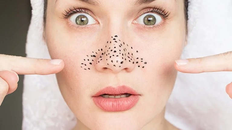komedo-blackheads-whiteheads