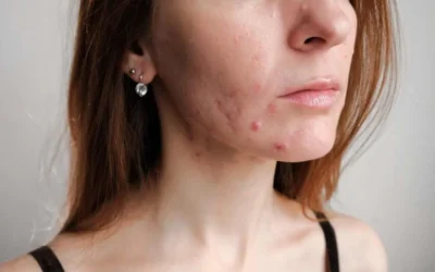 Jerawat Nodul: Penyebab, Ciri-ciri, dan Cara Mengatasinya