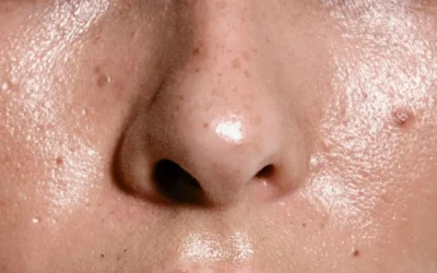 Cara Merawat Kulit Berminyak: Panduan Lengkap untuk Kulit Sehat