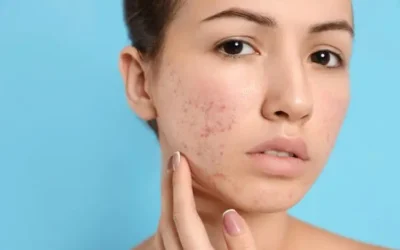 Bruntusan vs Jerawat: Apa Bedanya dan Bagaimana Mengatasinya?