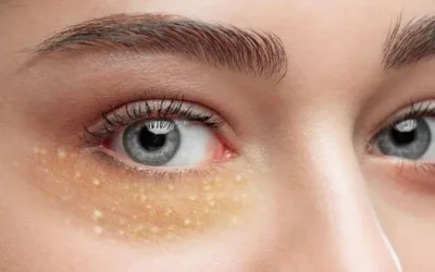 Komedo vs Milia: Perbedaan, Penyebab, dan Cara Mengatasinya