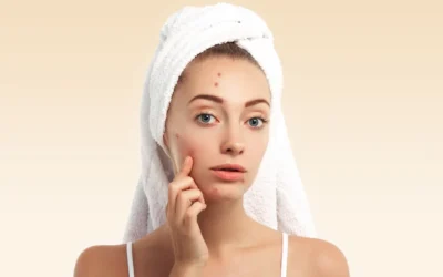 Spot Drying Lotion: Solusi Praktis untuk Jerawat Aktif