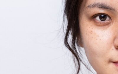 10 Cara Menghilangkan Flek Hitam di Wajah