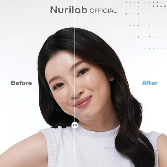 Nurilab conclearing acne