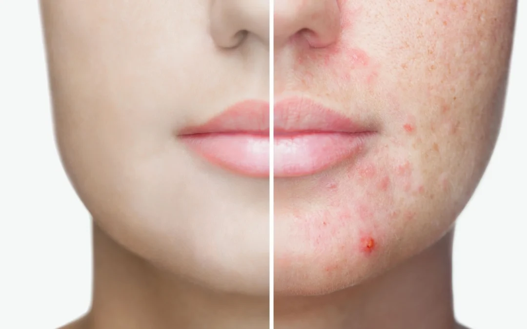 Apa Itu Non-comedogenic dan Kenapa Penting untuk Kulit Remaja?