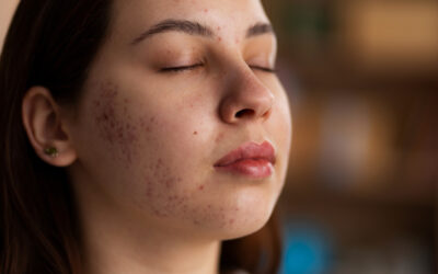 Perbedaan Purging dan Breakout Saat Pakai Skincare Jerawat