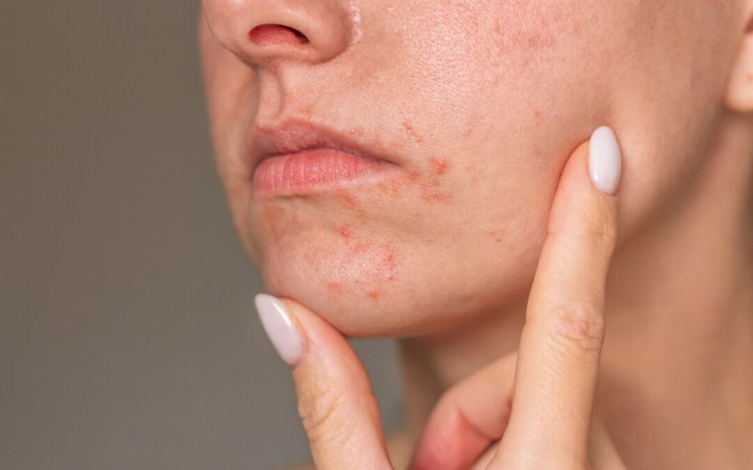 Cara Menghindari Iritasi Kulit saat Mencoba Produk Baru