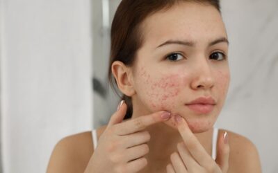 Skincare dan Hormon Remaja: Kenapa Jerawat Sering Muncul di Masa Pubertas?