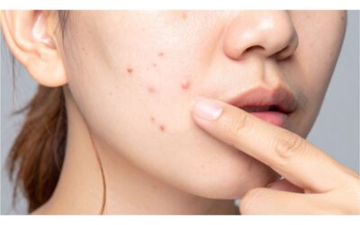 Kesalahan dalam Pemakaian Produk Spot Treatment Obat Totol Jerawat