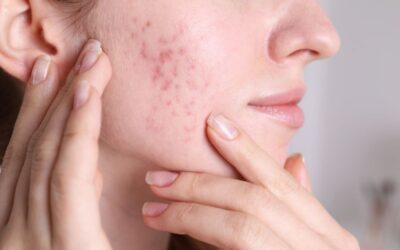 Panduan Temporary Acne: Jerawat Musiman dan Cara Mengatasinya