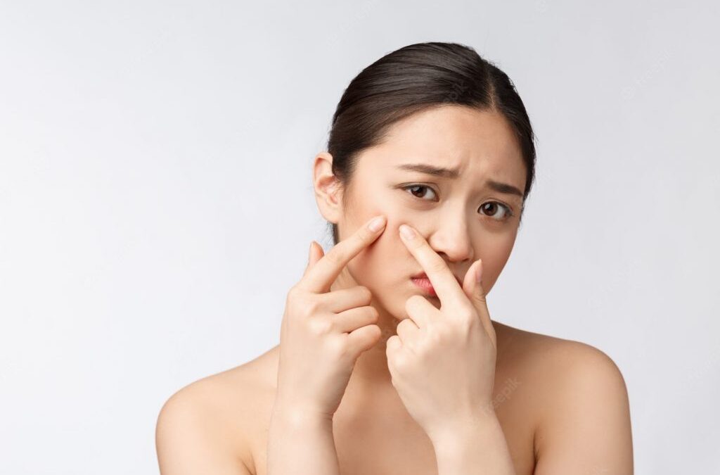 Mitos Kecantikan: Bahaya Memencet Jerawat untuk Kulit Wajah