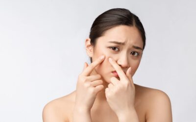 Mitos Kecantikan: Bahaya Memencet Jerawat untuk Kulit Wajah