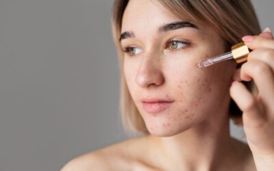 Skincare untuk Bekas Jerawat PIE: Cara Efektif Menghilangkan Kemerahan di Wajah