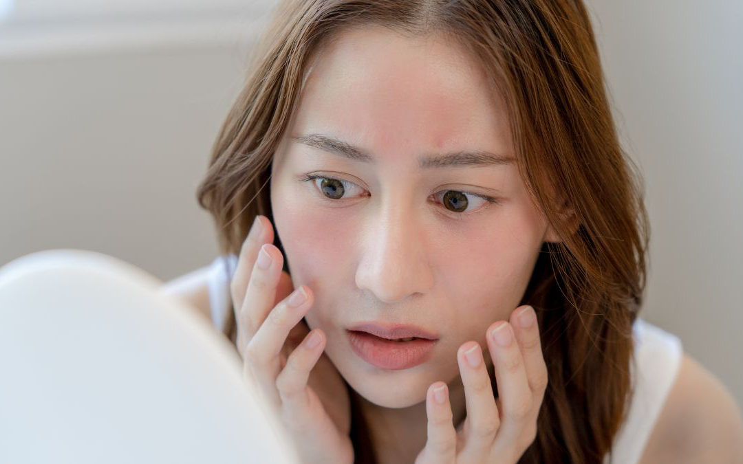 Mengapa Jerawat Hormonal Sering Muncul? Penyebab dan Solusinya