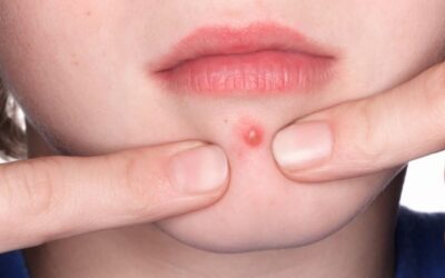 Jerawat Nanah: Penyebab, Perawatan, dan Cara Pencegahannya