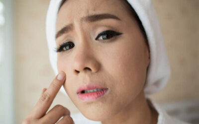 7 Kebiasaan Sehari-hari yang Bisa Memicu Jerawat Remaja