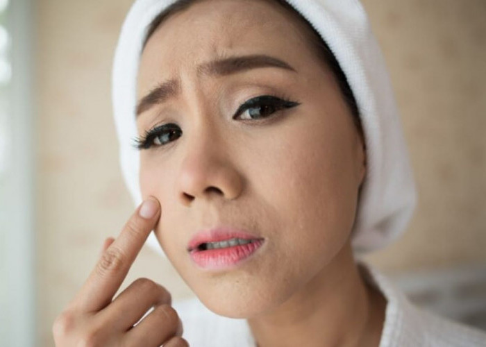 7 Kebiasaan Sehari-hari yang Bisa Memicu Jerawat Remaja