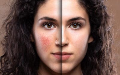 Panduan Memilih Skincare Saat Kulit Sedang Flare-up