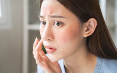 Benarkah Kulit Kering Tidak Mungkin Mengalami Jerawat? Fakta yang Perlu Diketahui