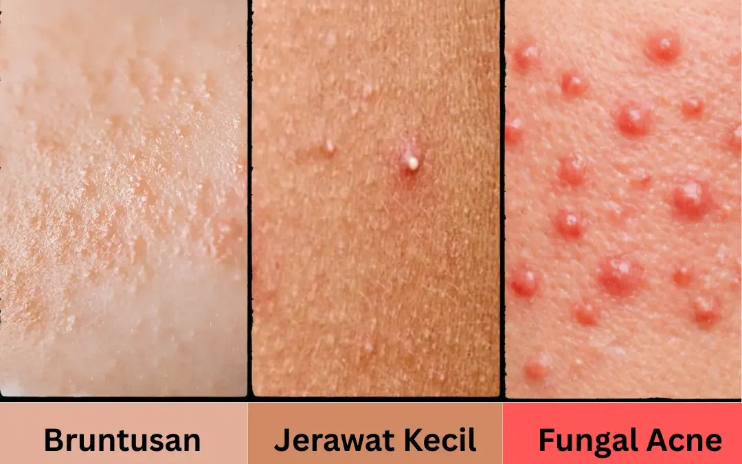 Perbedaan Bruntusan, Jerawat Kecil, dan Fungal Acne