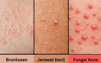 Perbedaan Bruntusan, Jerawat Kecil, dan Fungal Acne