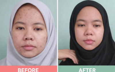 Perjalanan 14 hari Menghilangkan Bruntusan Pakai Nurilab Acne Conclearing