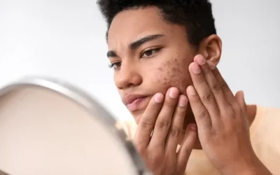 Jerawatan karena Keringat Berlebih? Ini Skincare untuk Anak Ekskul Outdoor