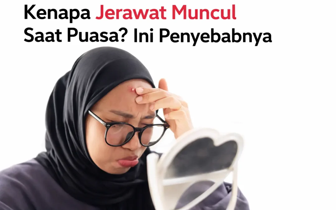 Kenapa Jerawat Muncul Saat Puasa Ini Penyebabnya