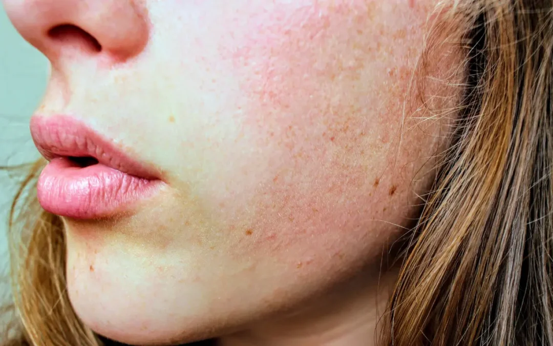 Kulit Sensitif atau Eczema