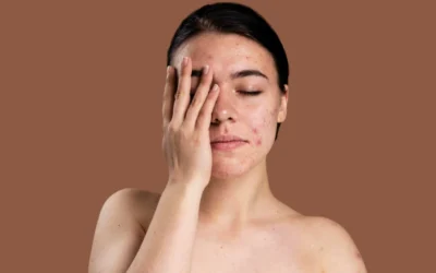 Jerawat yang Tak Kunjung Sembuh: Penyebab dan Solusinya