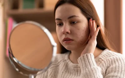 Apakah Bekas Jerawat Bisa Hilang dengan Sendirinya?
